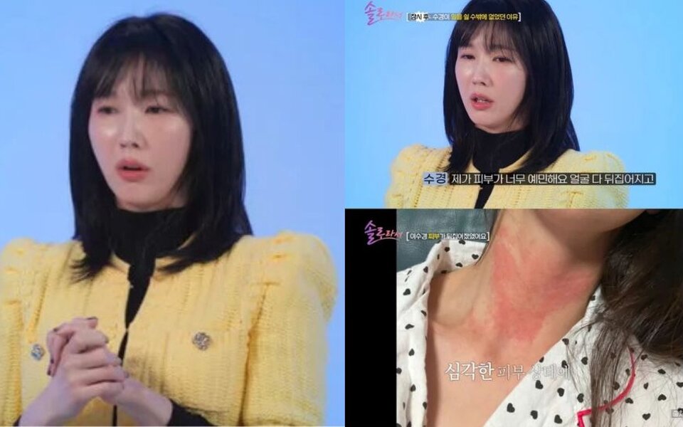 Image for Actress Lee Soo Kyung Reveals She Almost Quit Acting due to a Mysterious Skin Condition